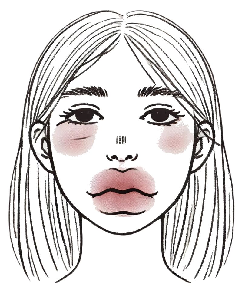 ACE阻害薬の副作用による唇の腫れ（血管浮腫）の症状を示す手書き風イラスト