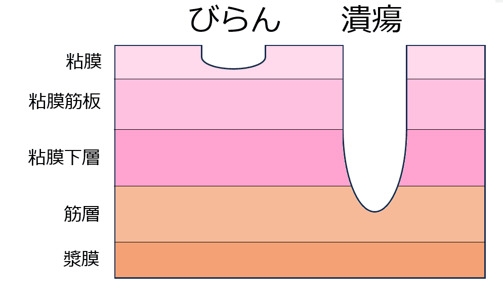 粘膜の断面図を用いて、びらんと潰瘍の違いを示した比較イラスト。びらんは粘膜の表層にとどまる浅い傷、潰瘍は粘膜下層より深い傷として描かれている。