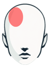 片頭痛の痛みの部位を示すイラスト。頭の片側に赤丸があり、片頭痛が片側に多いことを視覚的に説明している。