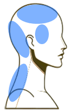 緊張型頭痛の痛みの部位を示すイラスト。頭全体（後頭部やこめかみ周辺）、肩、首に青丸を付け、好発部位を視覚的に説明している。