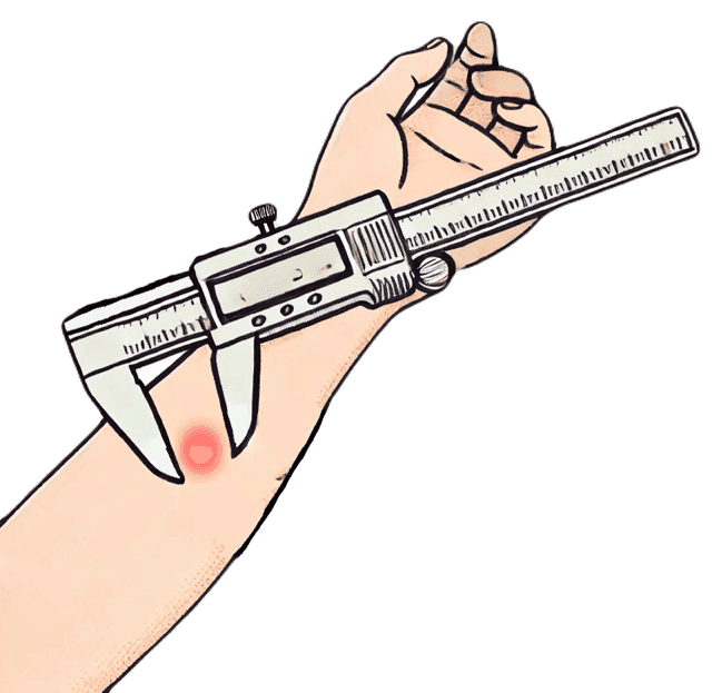 ツベルクリン反応後、腫れの大きさを測定器具で測定している様子。