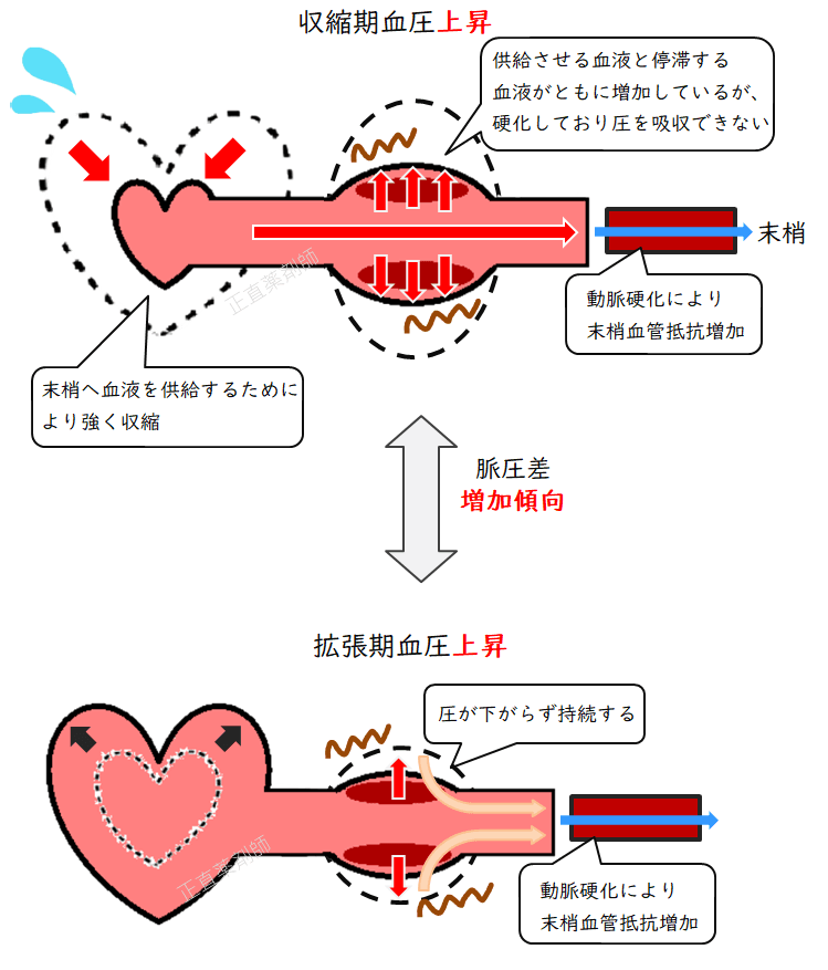 太い血管と細い血管がどちらも動脈硬化を起こしている場合の収縮期血圧と拡張期血圧の比較イラスト。両方の血圧が上昇している様子を示す。