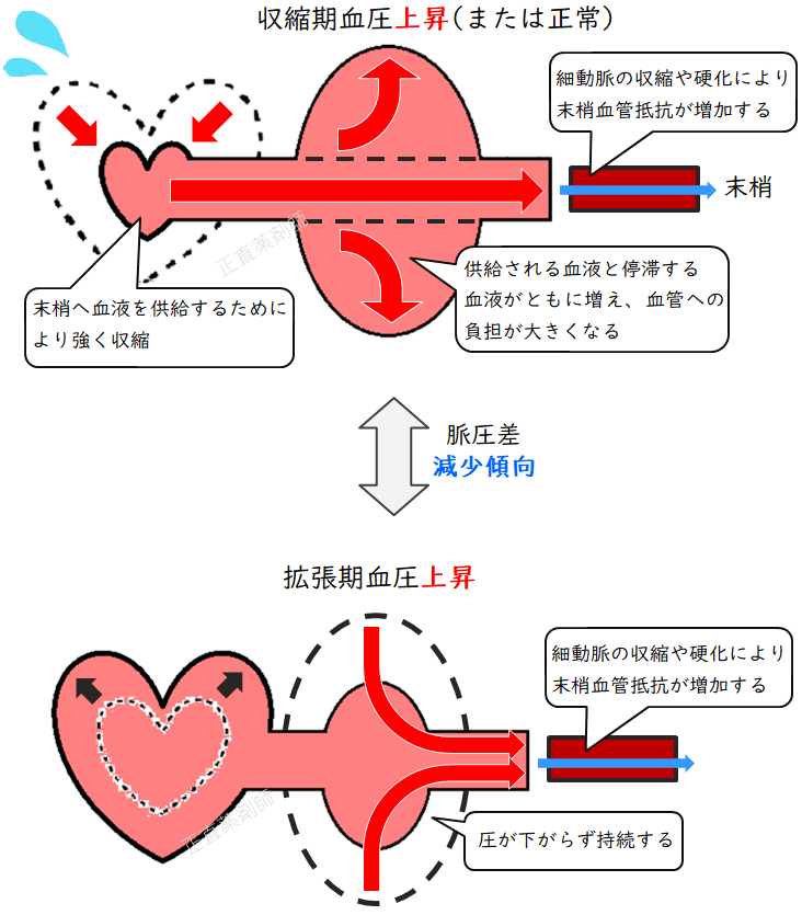 細い血管が動脈硬化した場合の収縮期血圧と拡張期血圧の比較イラスト。拡張期血圧が特に上昇している様子を示す。